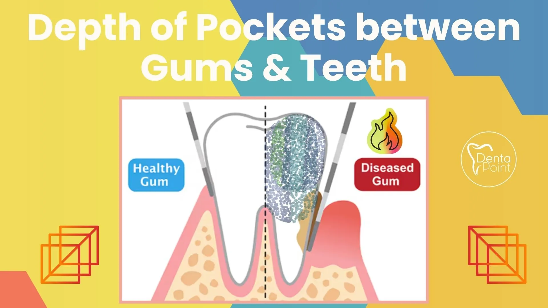 Depth of pockets between gums & teeth